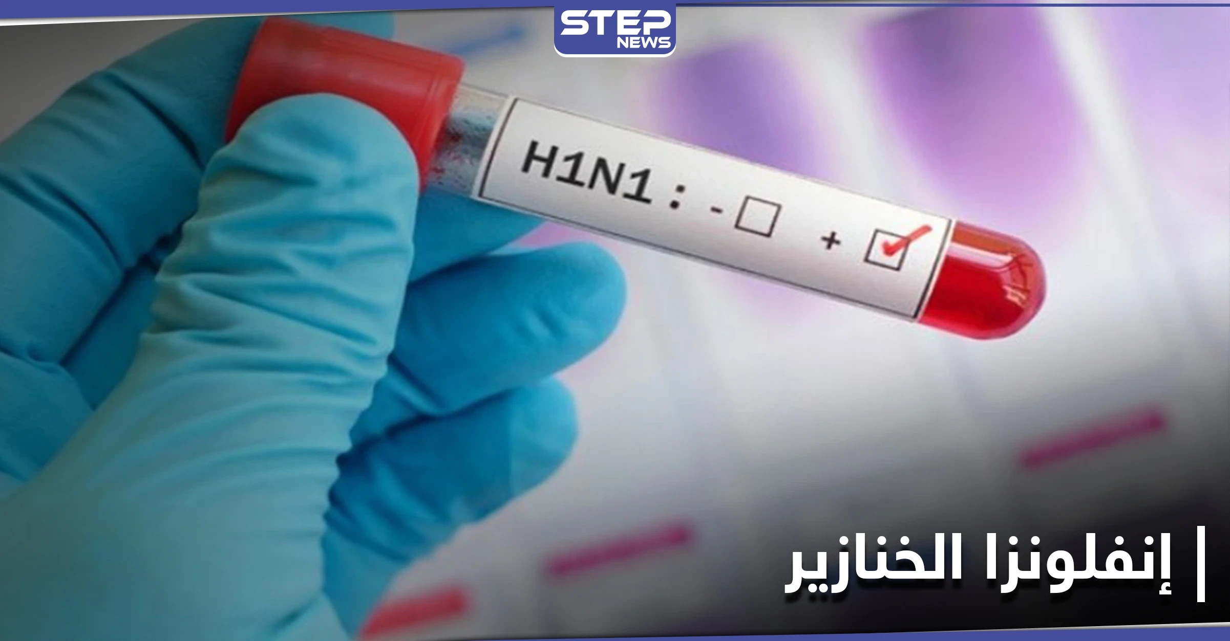 كندا تسجل أوّل حالة إصابة بمرض إنفلونزا الخنازير النادر تزامناً مع ارتفاع إصابات كورونا