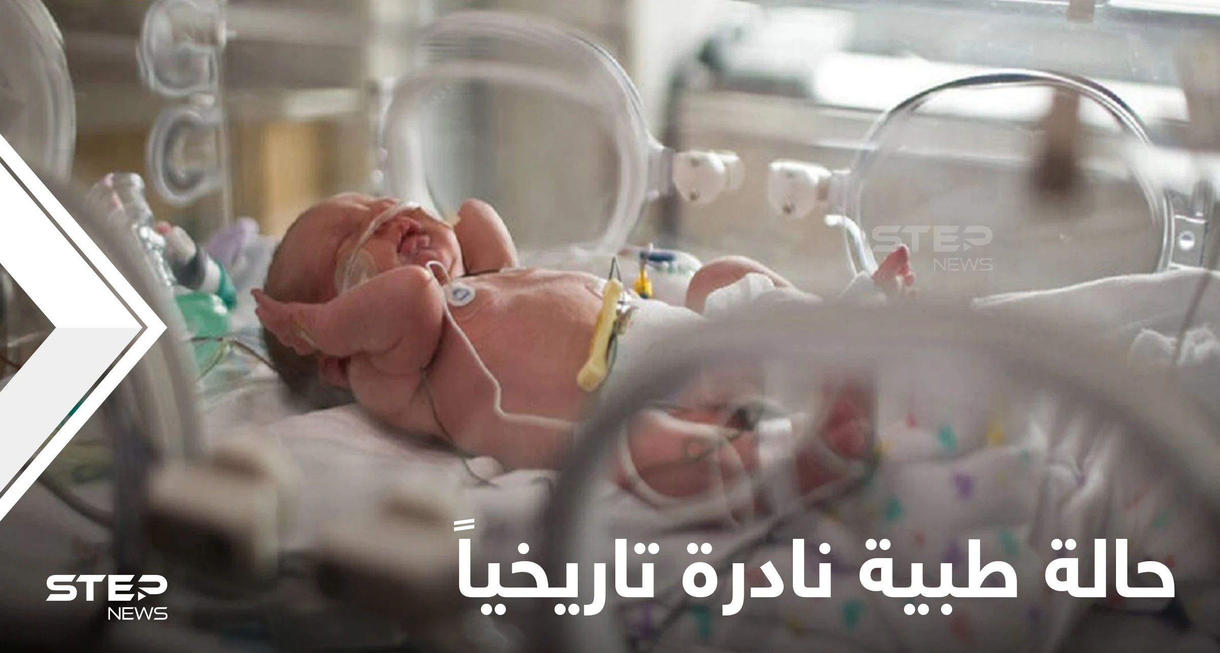 بحالة طبية نادرة للغاية.. ولادة طفل برازيلي بذيل بشري حقيقي مع كرة بنهايته (صور)