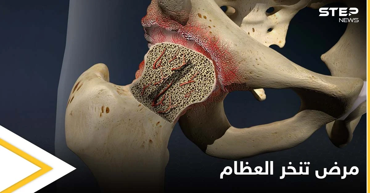 ما هو تنخر العظام.. وماهي أنواعه وأهم الأسباب المؤدية إليه