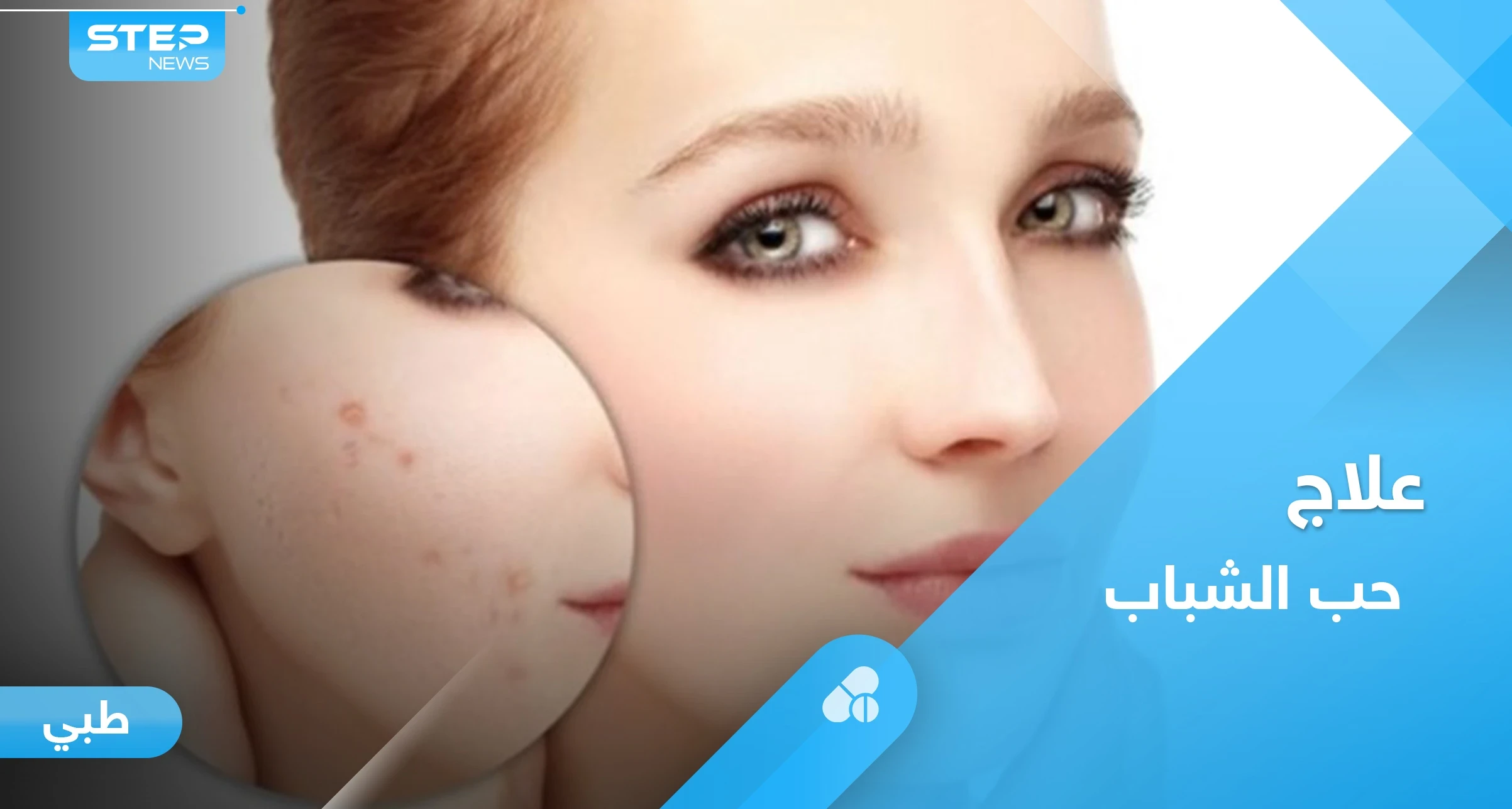 وصفات طبيعية لعلاج حب الشباب تعرف عليها