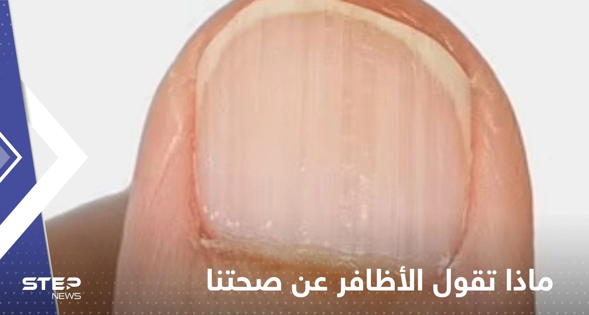 ماذا تقول الأظافر عن صحتنا؟.. تعرف على الحالات الخطيرة