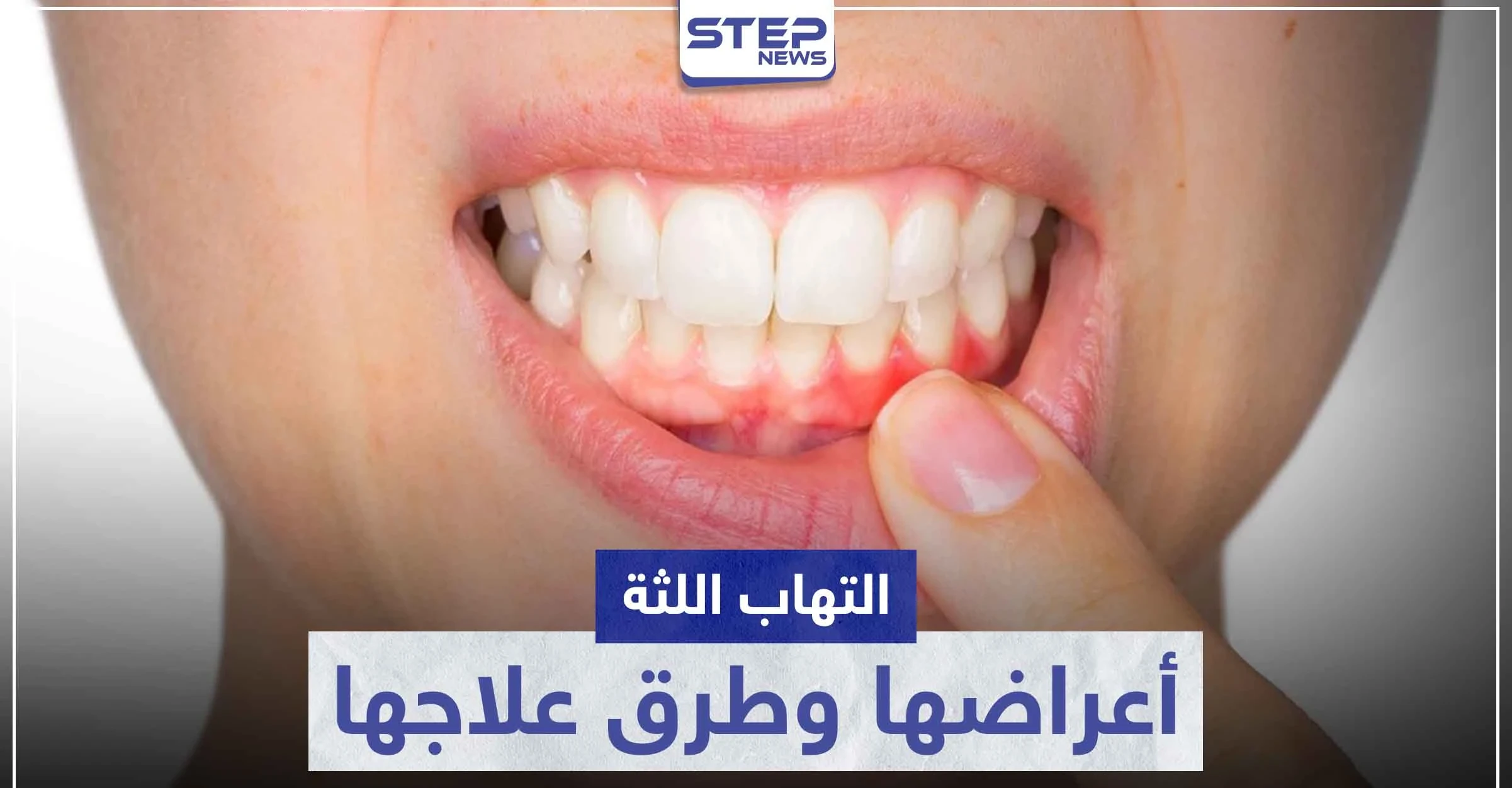 تعرّف على أكثر من كبسول لعلاج التهاب اللثة و ما هي أسبابها وأعراضها