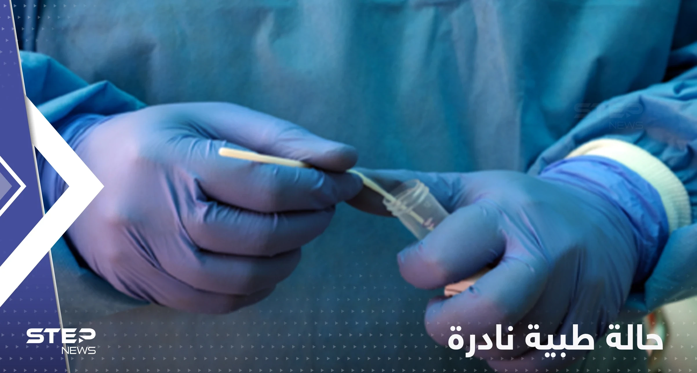 الإعلان لأول مرة عن شخص مصاب بكورونا والإيدز وجدري القردة معاً