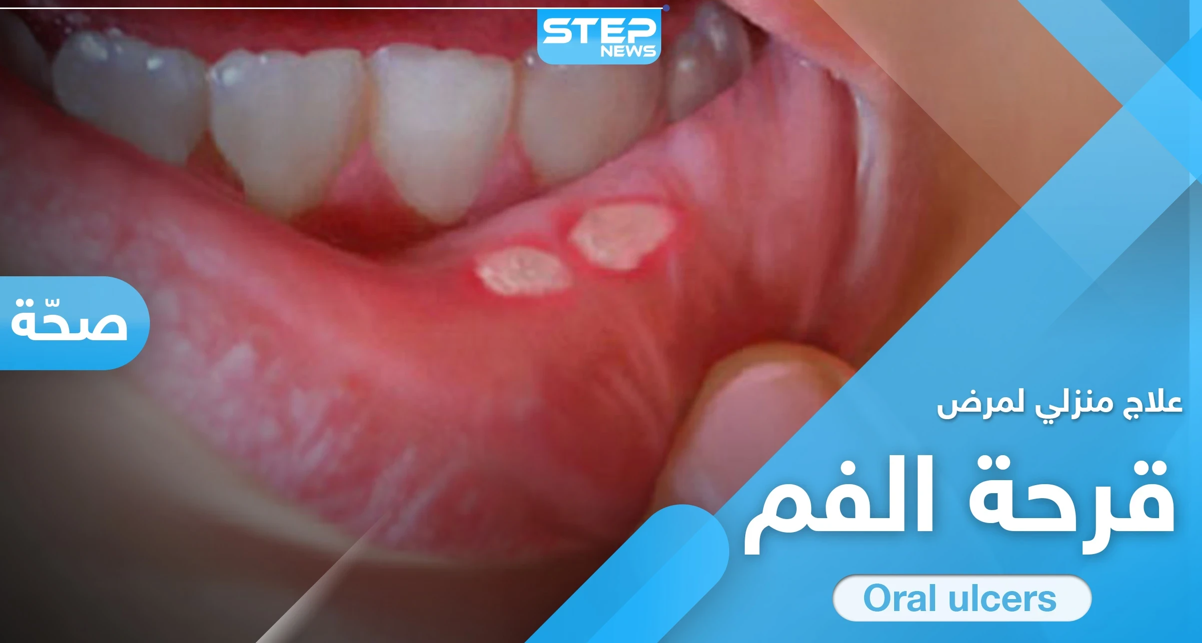 علاج قرحة الفم في المنزل.. إليك الطريقة و7 نصائح هامة