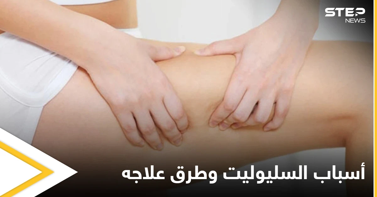 ماهو السليوليت ومأ أسبابه وإصابته للنساء بشكل أكبر إليك أهم المعلومات
