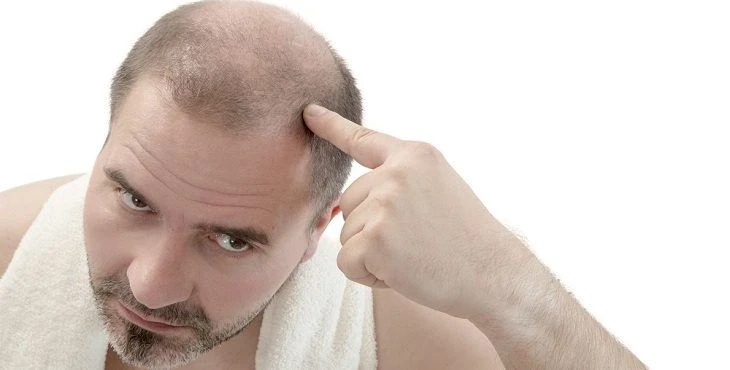 5 أسباب رئيسية تؤدي إلى تساقط الشعر