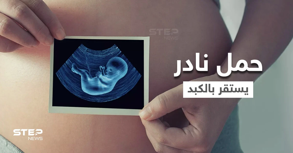 بالفيديو|| بحالة فريدة من نوعها في العالم.. حمل نادر لامرأة خارج الرحم استقر في الكبد