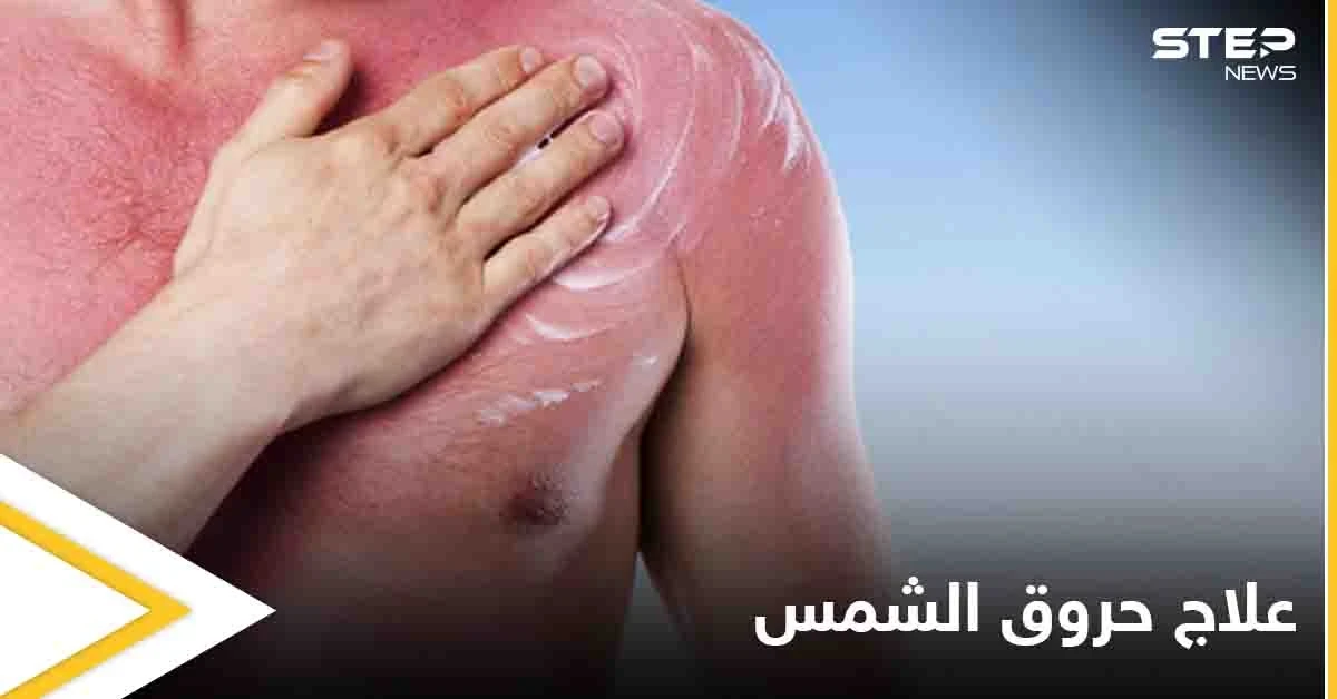تعرف على أنواع حروق الشمس وأفضل الطرق لعلاجها