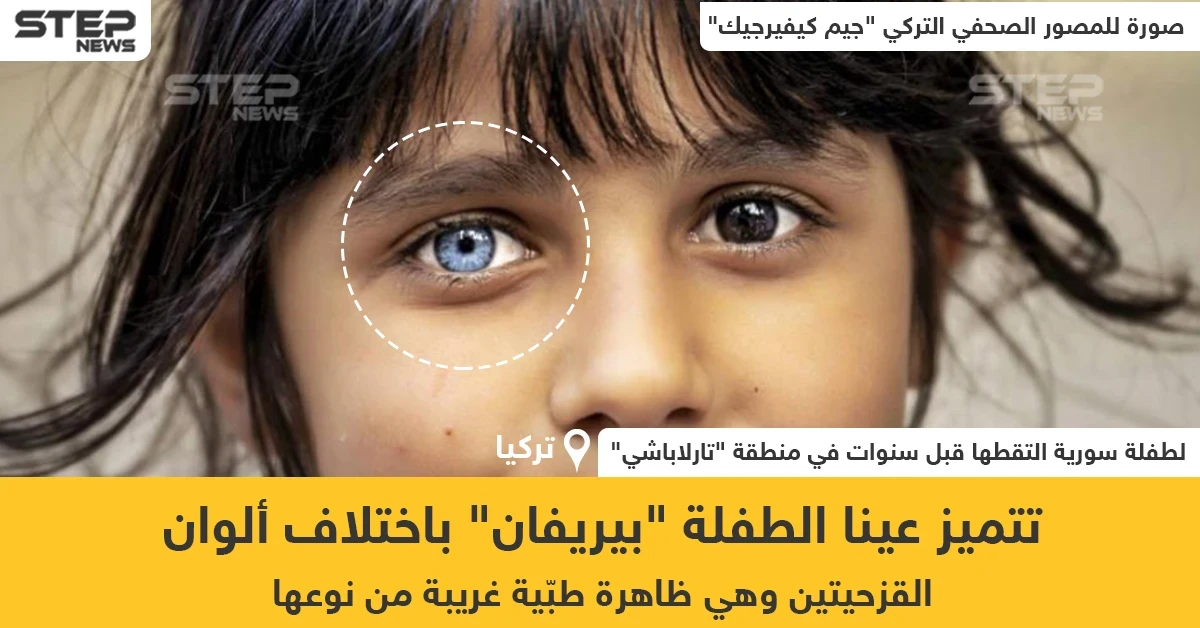 طفلة سورية تتميز باختلاف ألوان عينيها