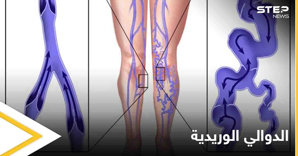 يسبب الكثير من الأعراض المزعجة.. تعرف على مرض الدوالي الوريدية وأسبابه وطرق الوقاية منه
