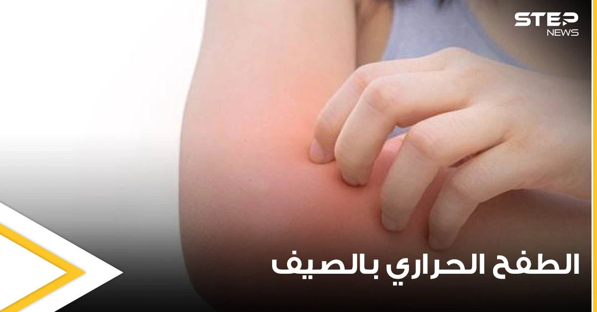الطفح الحراري في الصيف أعراضه وأسبابه وطرق علاجه