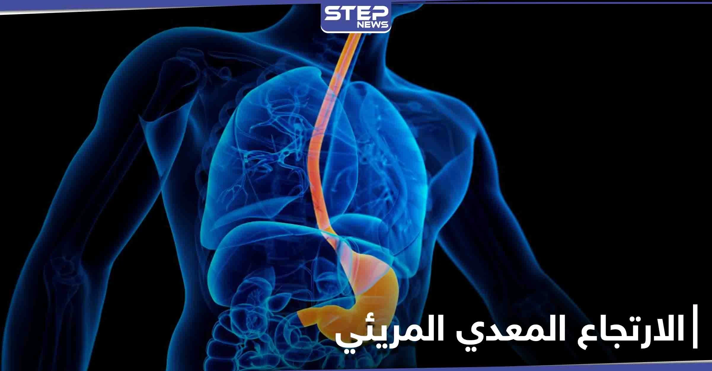 كيف تتخلص من آلام الارتجاع المعدي المريئي وما هي أسبابه وأعراضه الشائعة