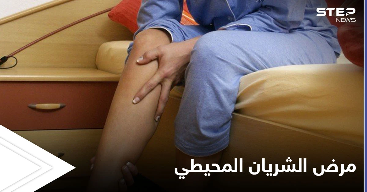 مرض الشريان المحيطي مشكلة صحية تصيب الأطراف وتتسبب بضعفها تعرف عليه