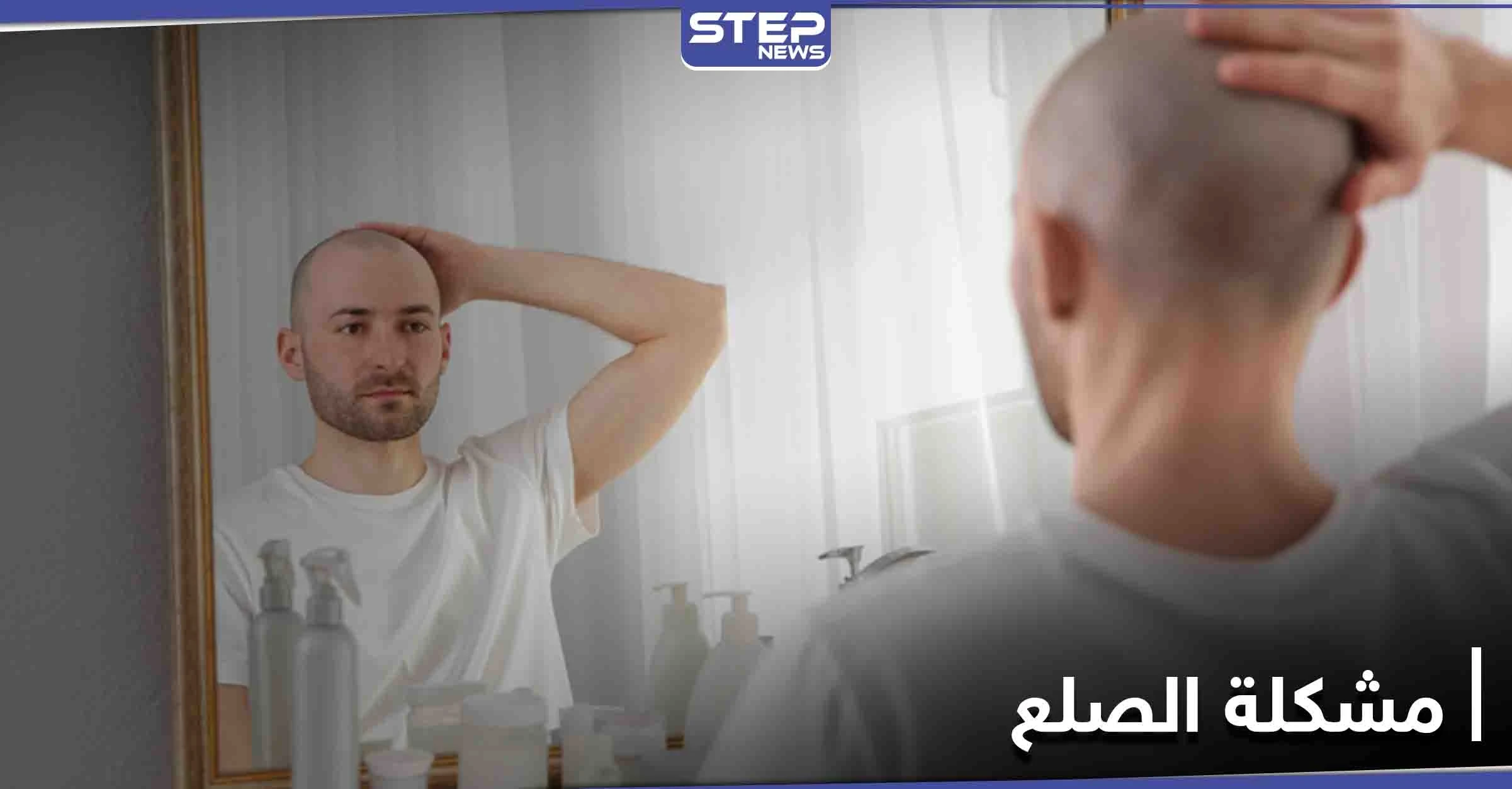 إذا كنت تعاني من مشكلة الصلع.. علماء يكتشفون حلاً بسيطاً لها