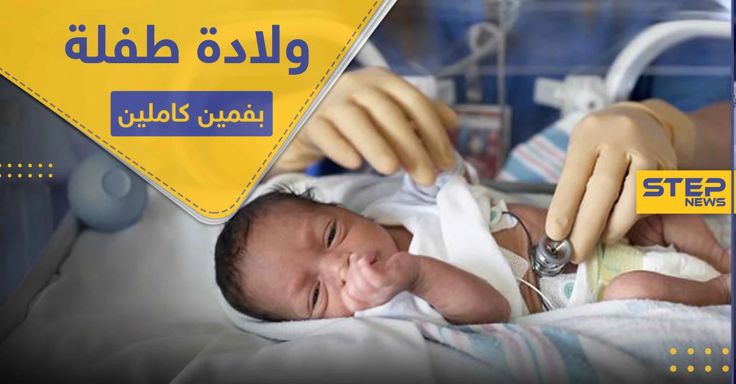 شاهد|| ولادة طفلة بفمين كاملين في حالة طبية نادرة