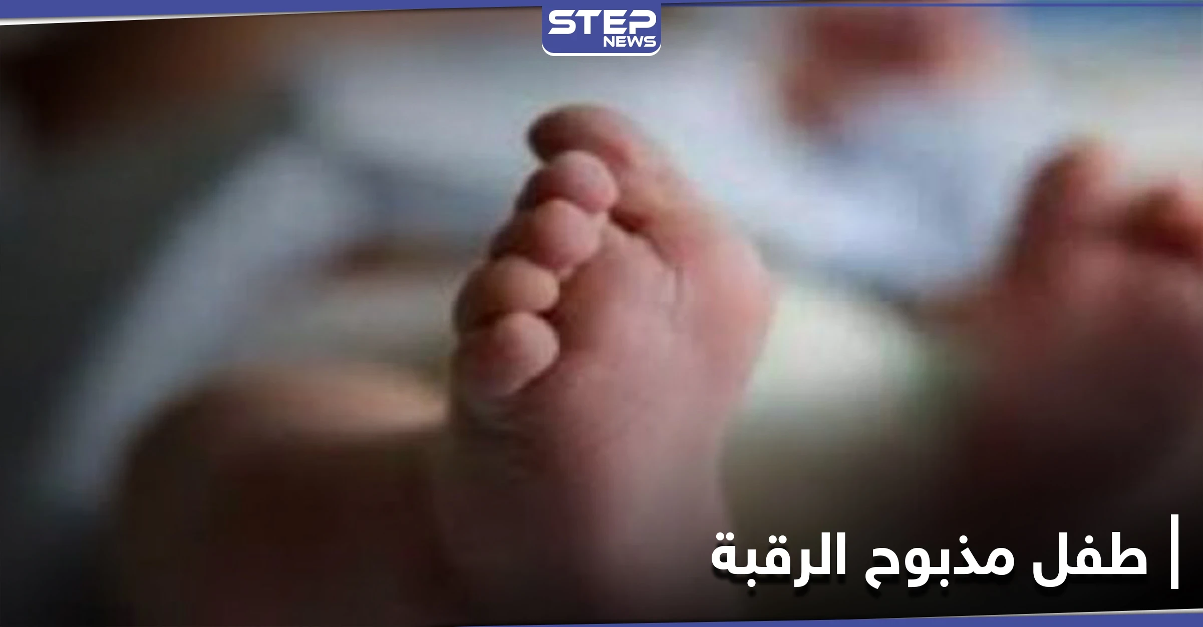 في حالة طبية نادرة .. ولادة طفل مذبوح الرقبة في مصر