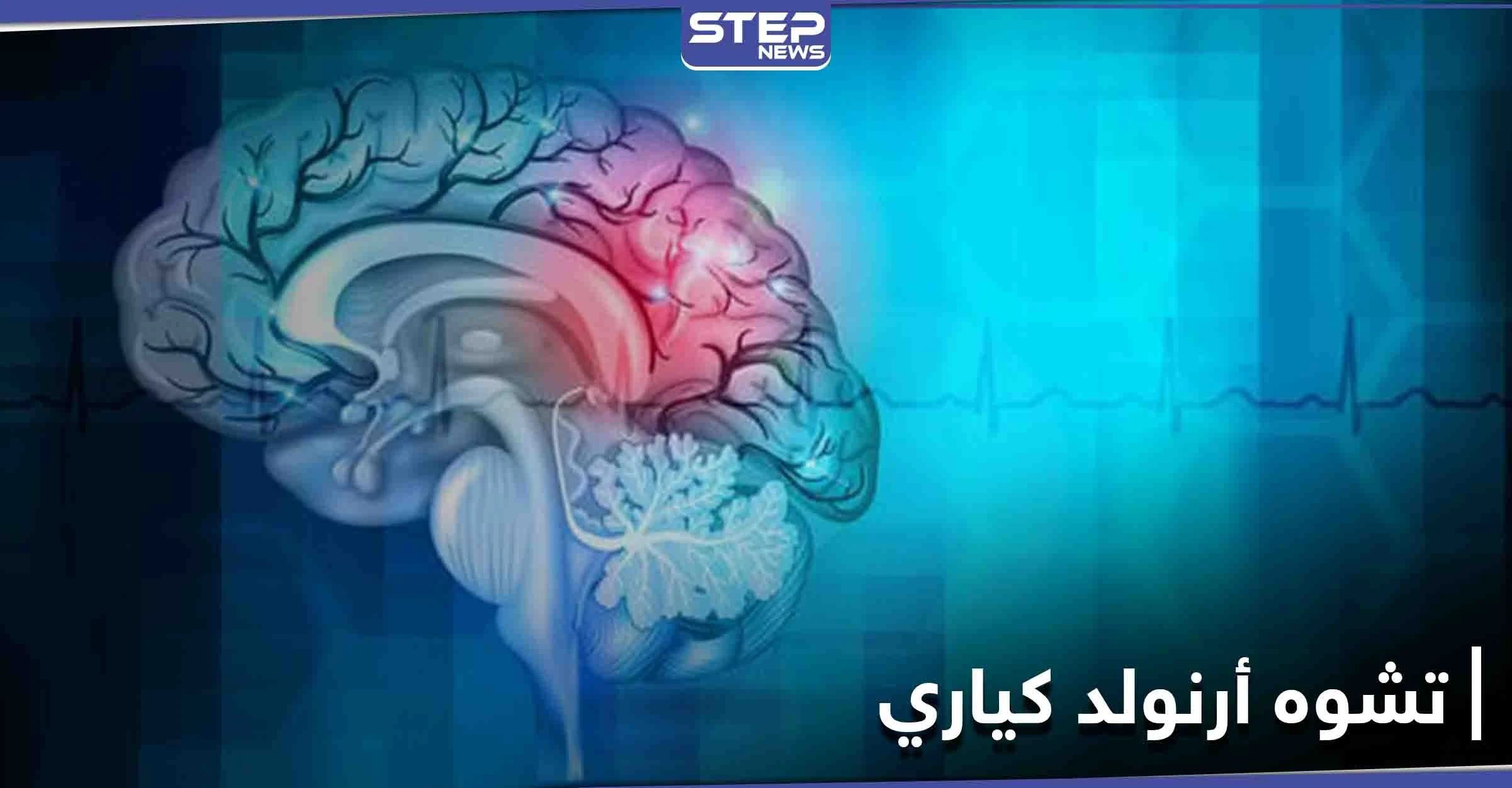 ماذا تعرف عن تشوه أرنولد كياري وأثره على النخاع الشوكي والحركة العضلية
