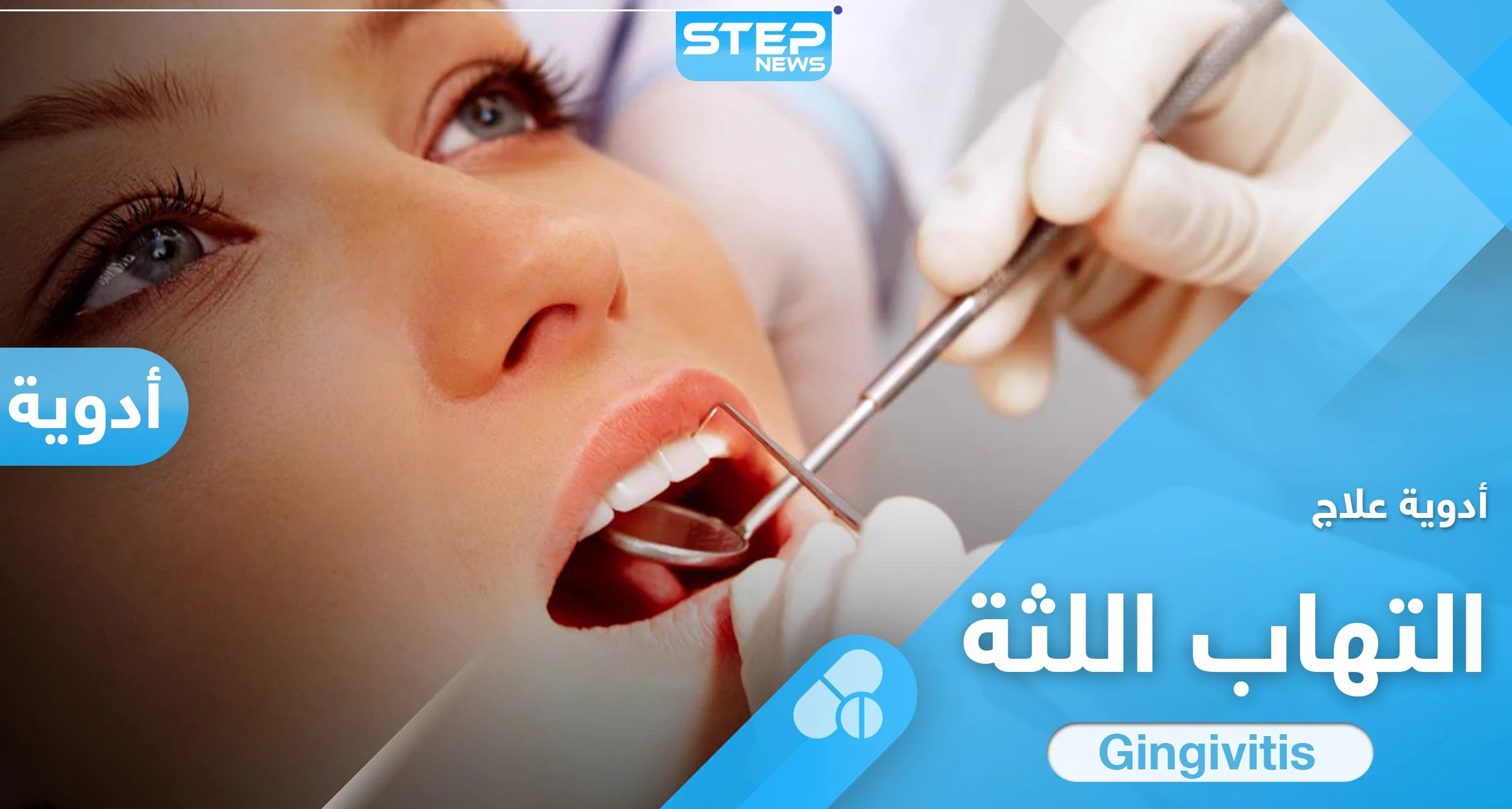 5 من افضل ادوية علاج التهاب اللثة المتعارف عليها إليك بها