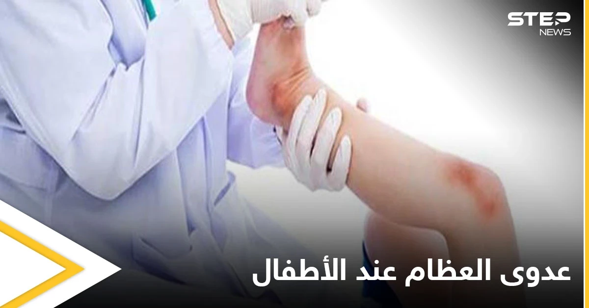 هل تصل الجراثيم إلى العظام وماهي عدوى العظام والمفاصل وخطورتها على الأطفال إليك أهم المعلومات