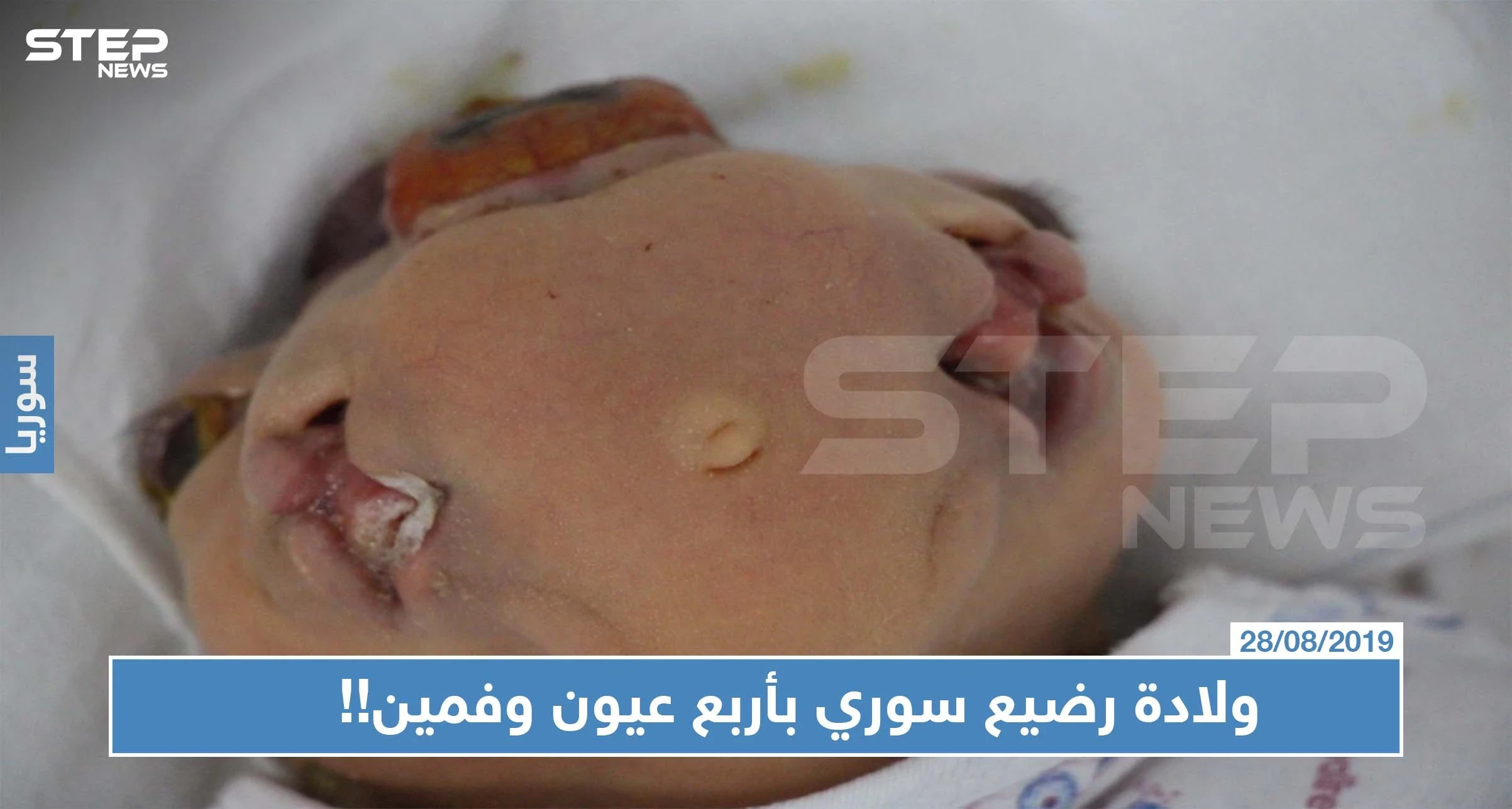 حالة نادرة: ولادة رضيع سوري بأربع عيون وفمين!!