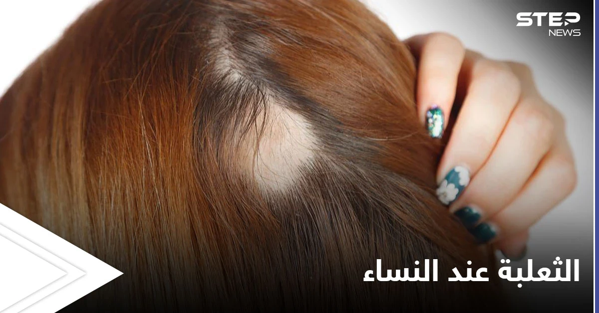 الثعلبة عند النساء.. تعرف على الأسباب وطرق العلاج