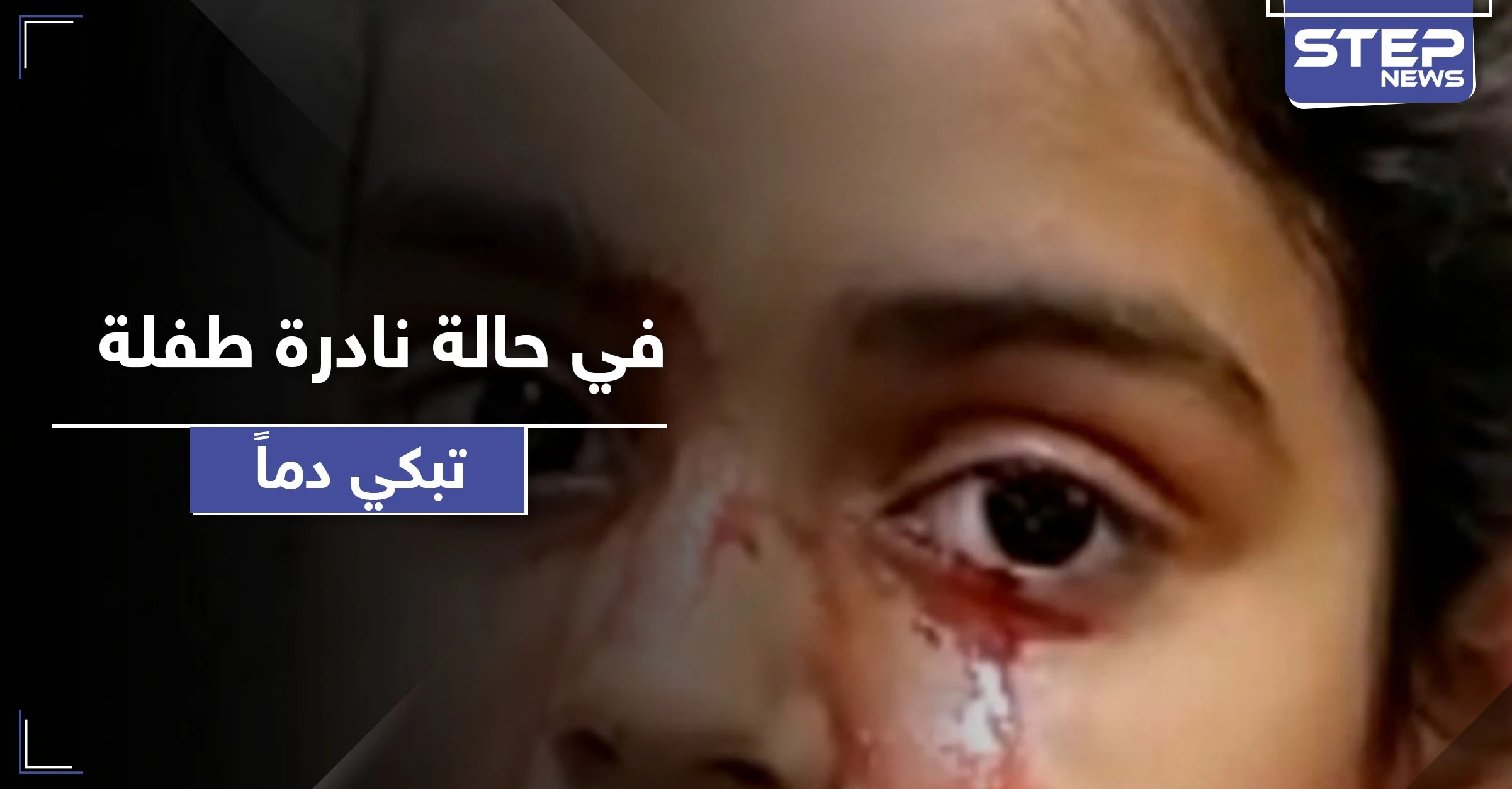 طفلة تبكي دماً بدل الدمع.. حالة طبية نادرة تربك الأطباء وهذه أسبابها