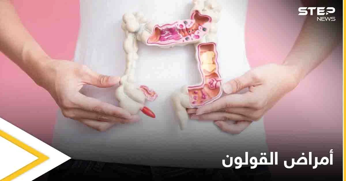 3 أمراض تصيب القولون تعرف على أعراضها وكيفية التفريق بينها
