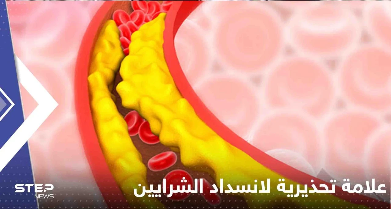علامة تحذيرية بسيطة تكشف انسداد الشرايين بسبب الكوليسترول.. إياك تجاهلها