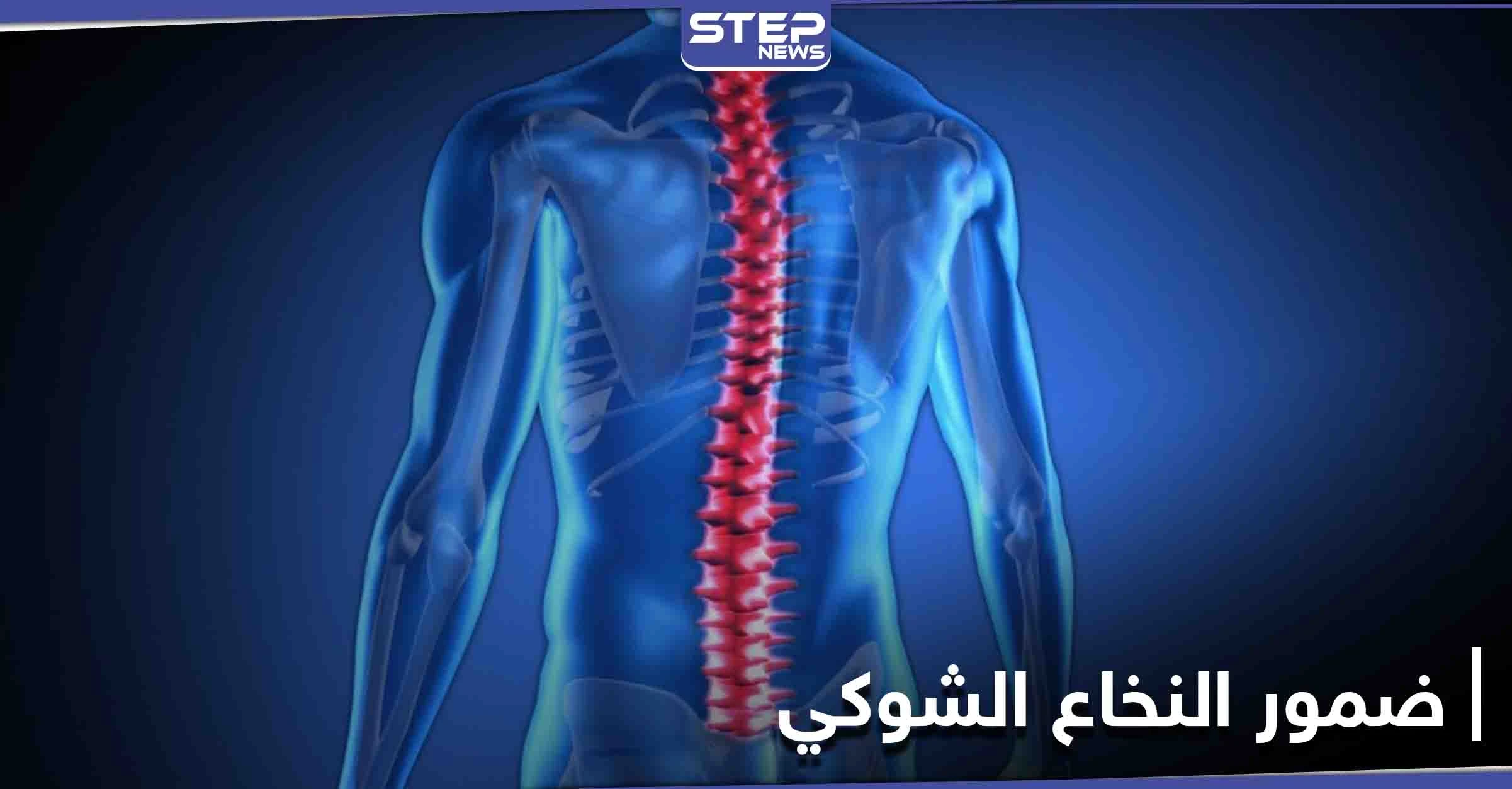تعرف على مرض ضمور النخاع الشوكي أسبابه ومراحل خطورته على حياة الإنسان