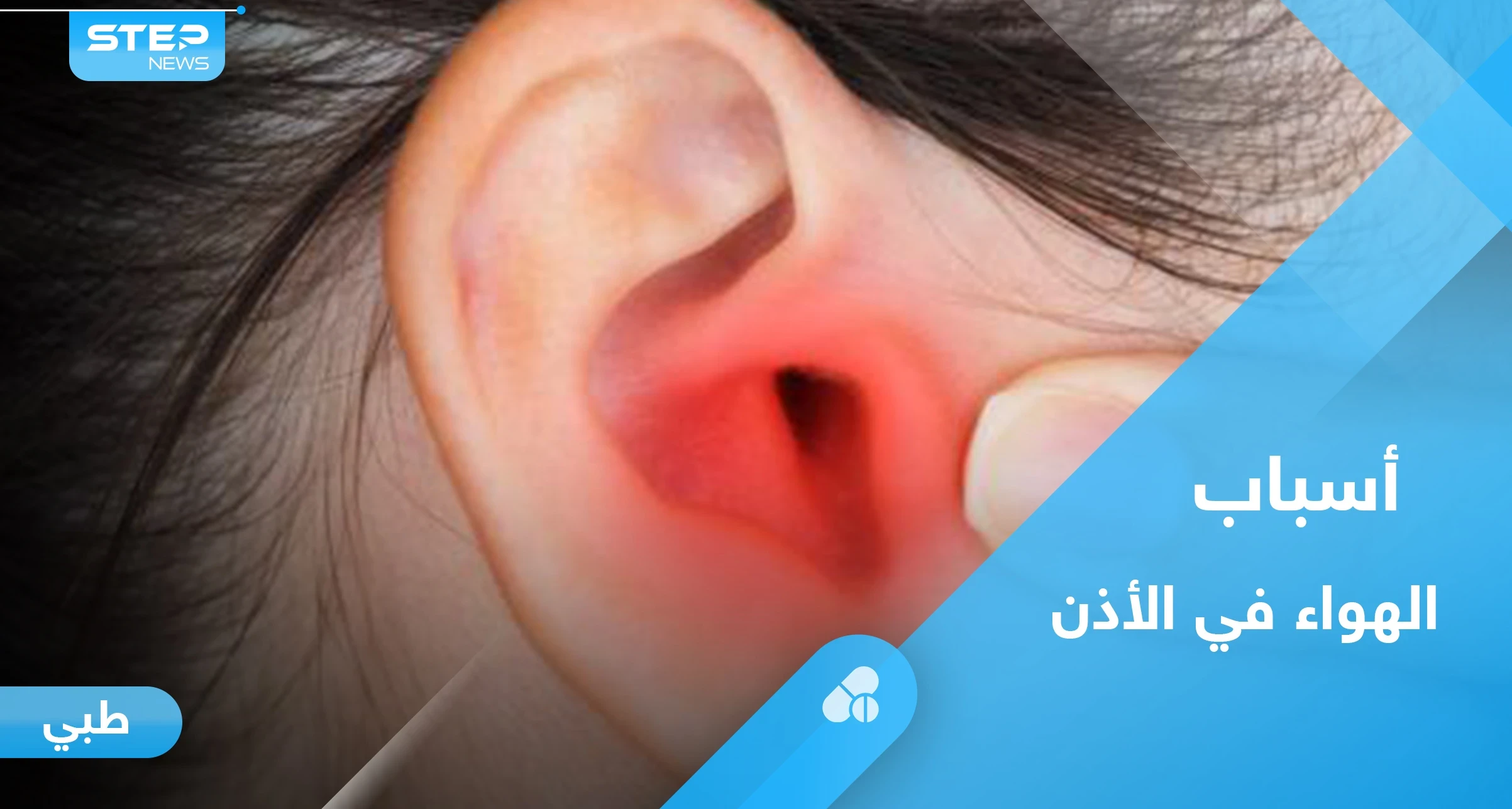هل شعرت يوماً بـ "هواء في الأذن".. إليك الأسباب وطرق العلاج