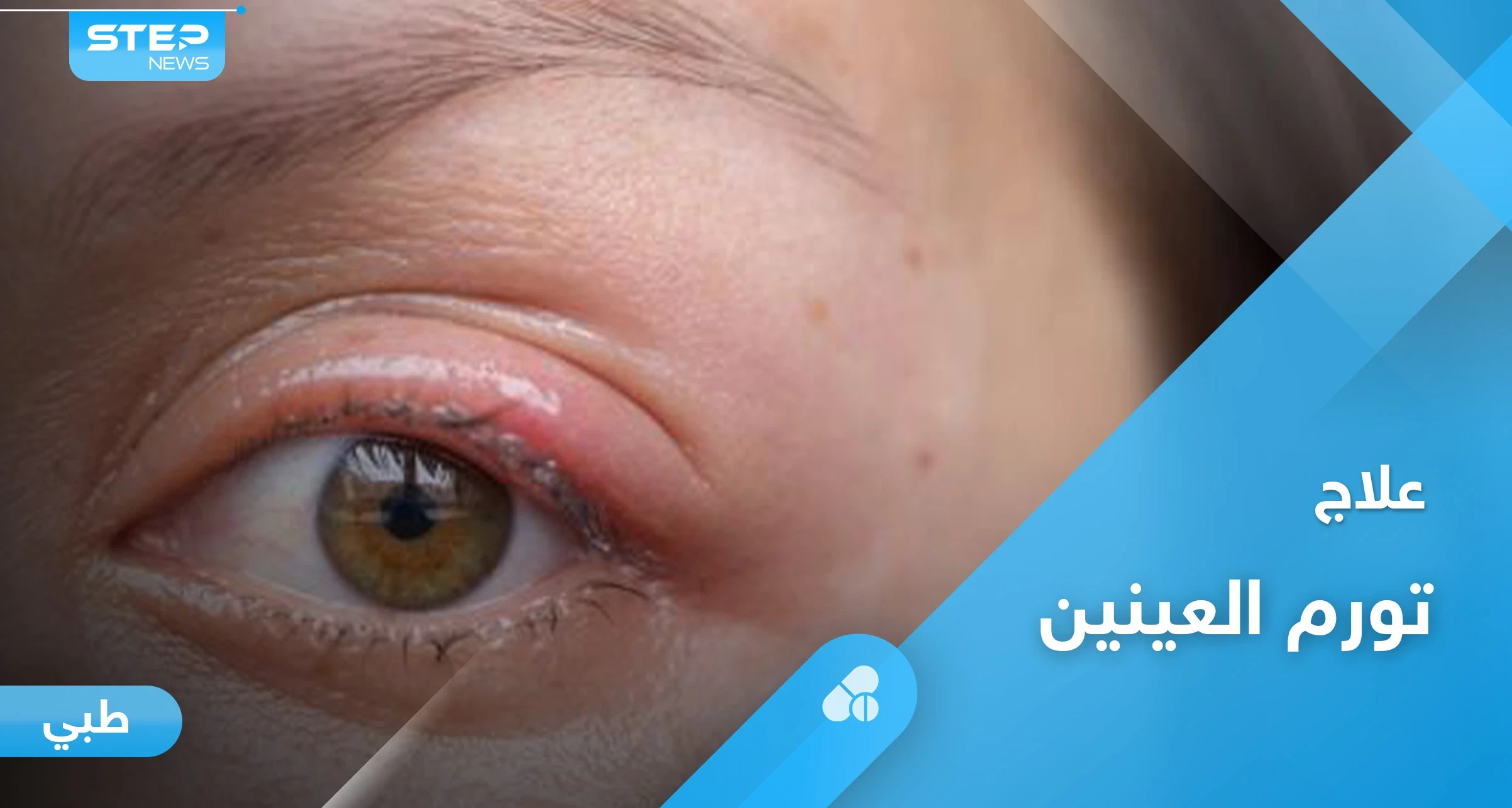 هل تعاني من تورم العينين.. إليك أهم الأسباب وطرق العلاج في المنزل