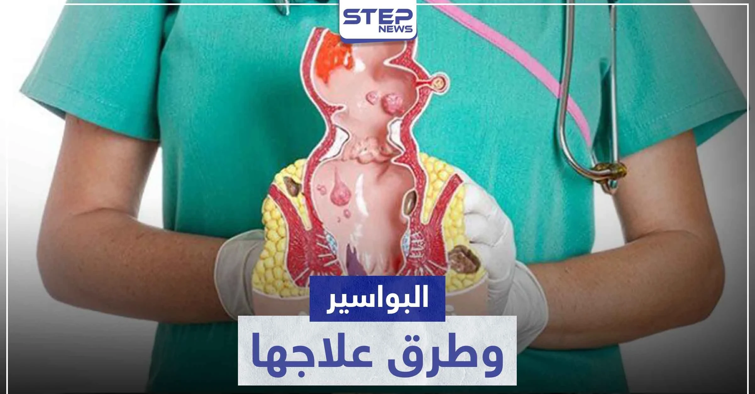 أفضل علاج للبواسير في المنزل و الصيدليات