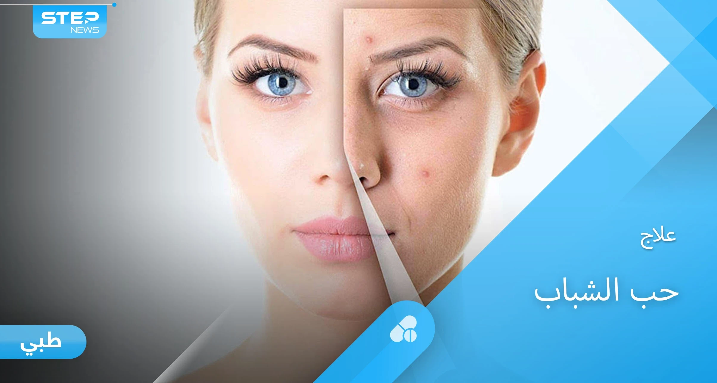 أسباب ظهور حب الشباب وطرق العلاج الفعالة إليك أهم المعلومات
