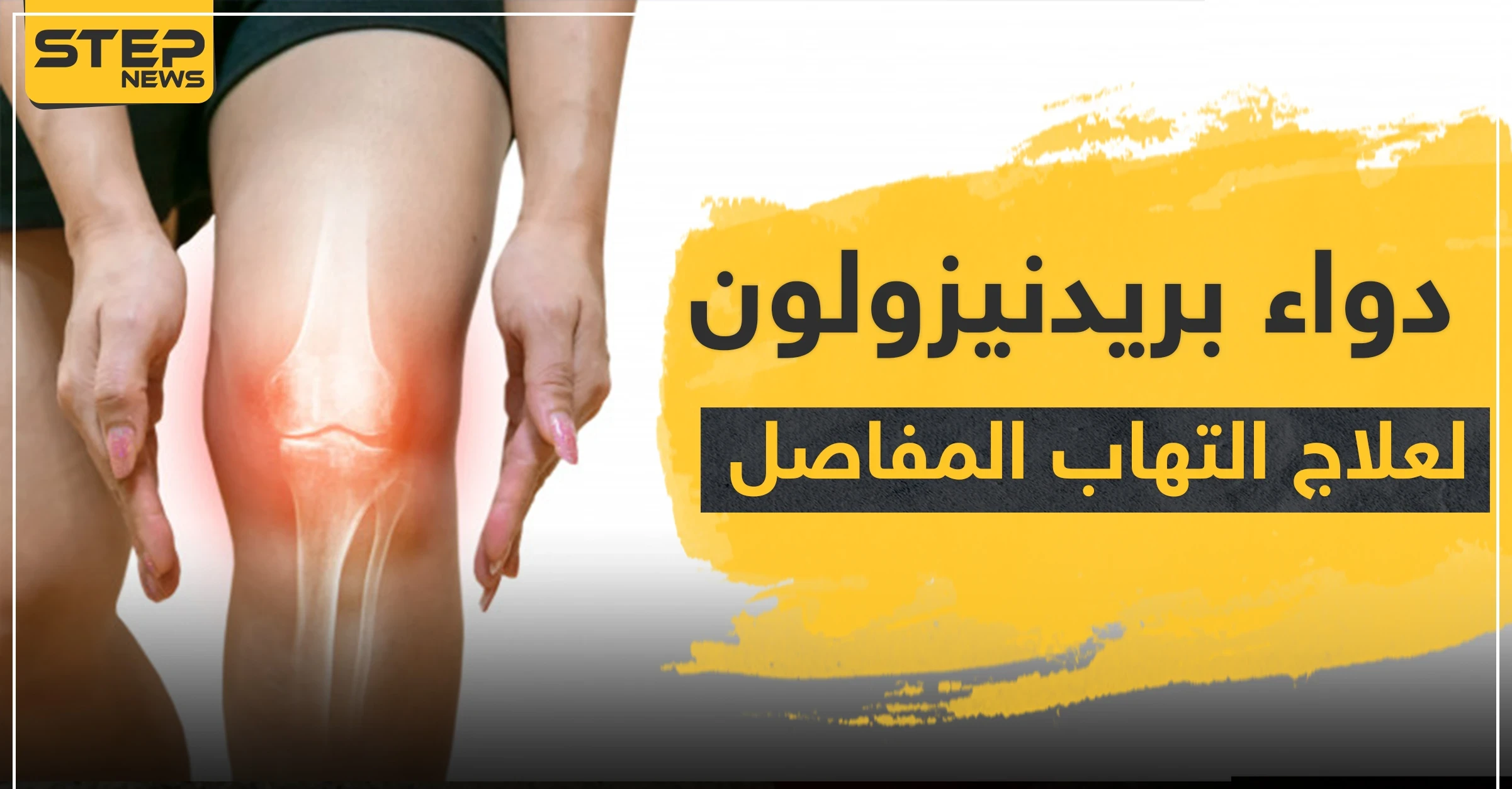 دواء prednisolone بريدنيزولون لعلاج التهاب المفاصل