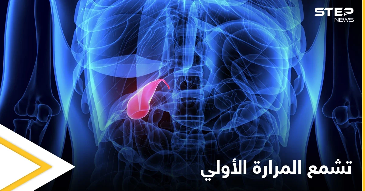 من أخطر الأمراض تشمع المرارة الأولي أسبابه وأعراضه وأهم المعلومات عنه