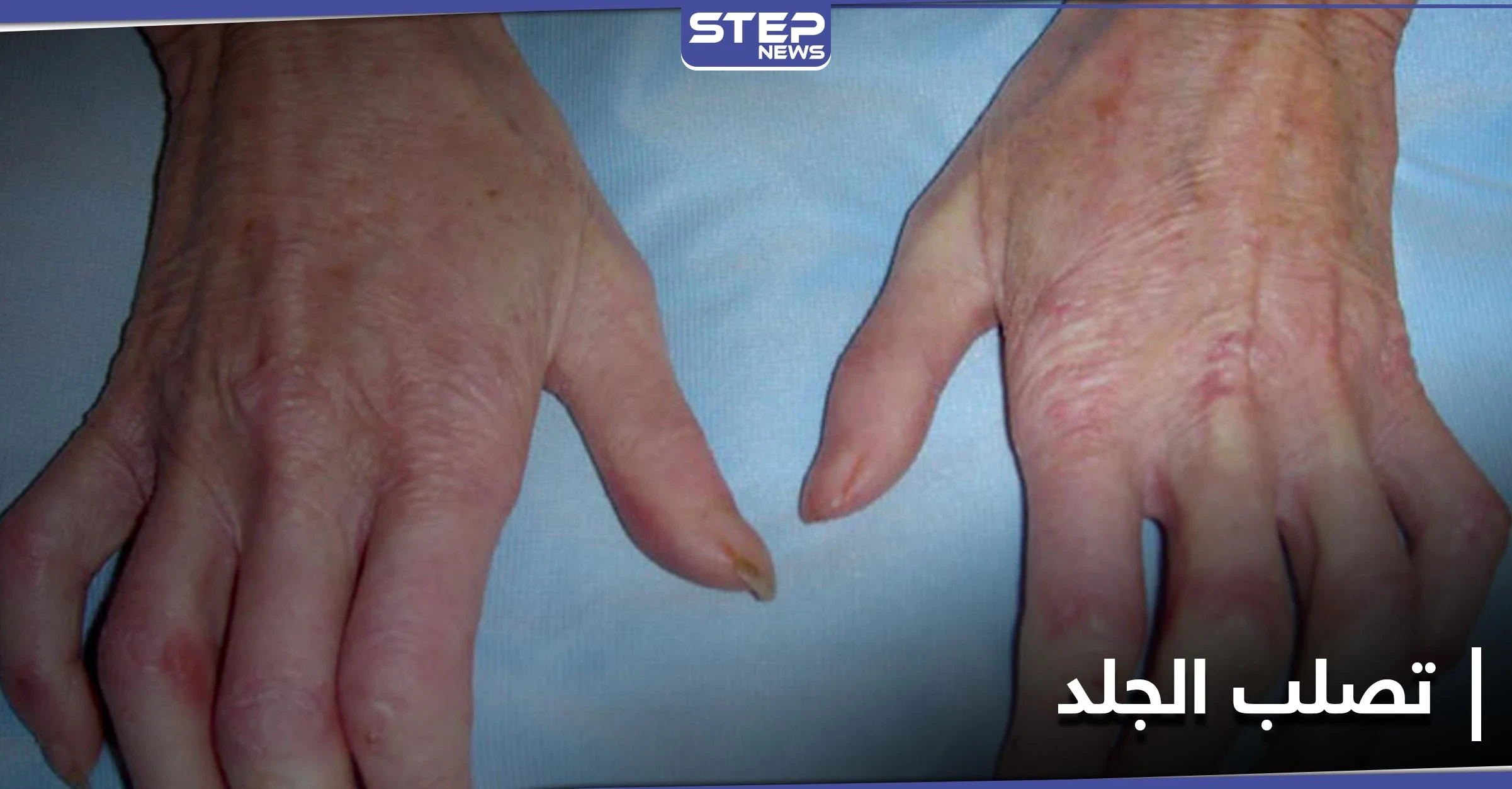 تعرف على مرض تصلب الجلد وآثاره على الأعضاء الداخلية بما فيها الكلى والرئتين
