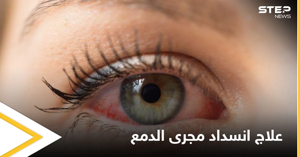 علاج انسداد مجرى الدمع لدى البالغين وأهم المعلومات عنه