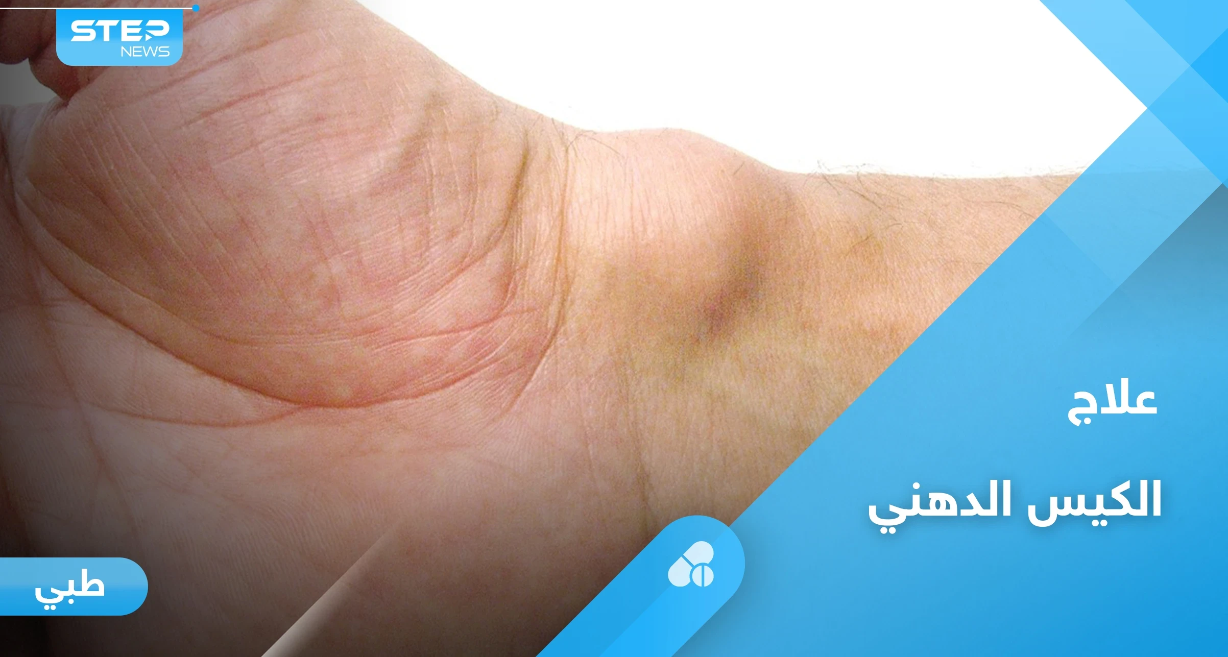 الكيس الدهني.. هل هو خطير وأبرز أعراضه وعلاجه إليك أهم المعلومات