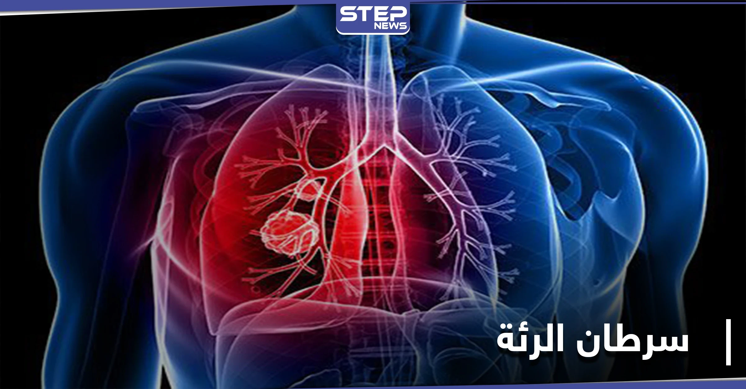 علامة تظهر في منطقة العين تدلُّ على الإصابة بـ سرطان الرئة.. إليك التفاصيل
