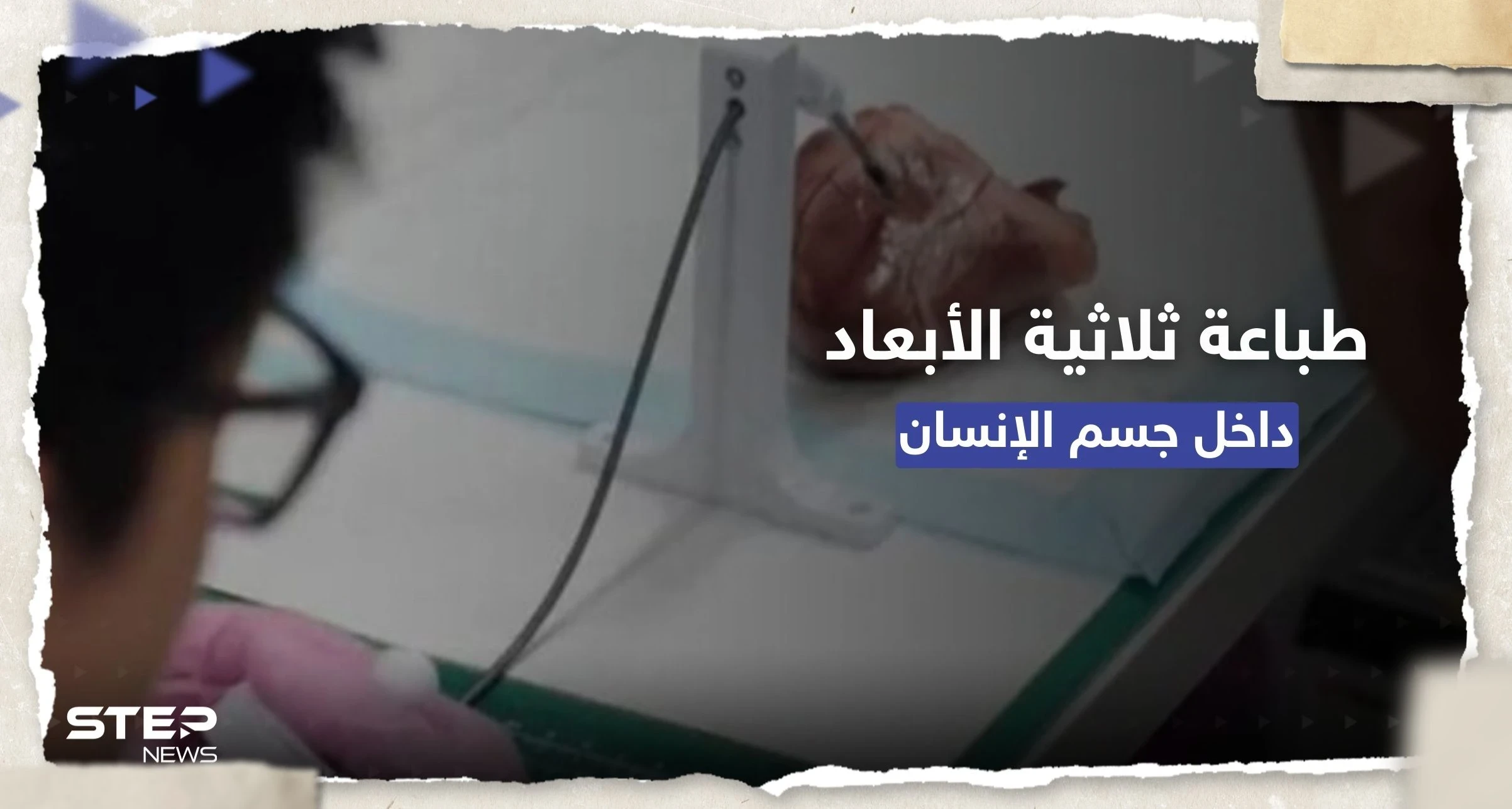 إنجاز علمي.. طباعة ثلاثية الأبعاد داخل جسم الإنسان