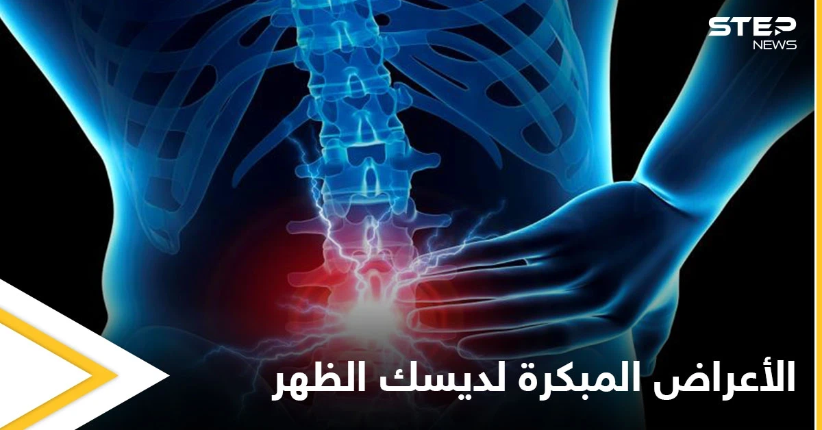 من أمراض العصر.. ديسك الظهر إليك أعراضه المبكرة وطرق علاجه