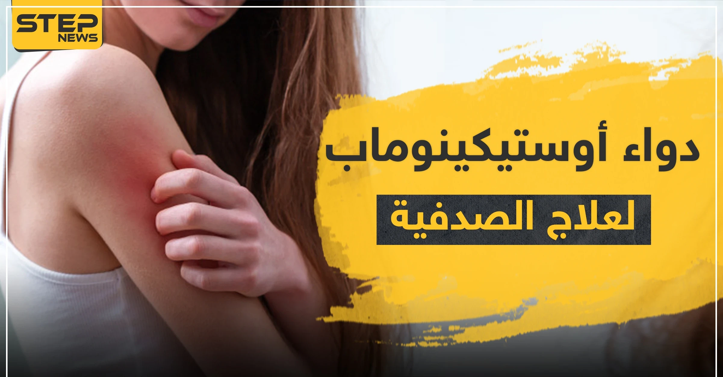 دواء أوستيكينوماب لعلاج الصدفية
