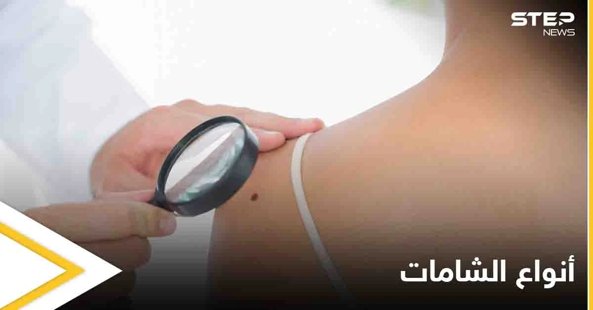 ماهي الشامة وهل لها علاقة بسرطان الجلد تعرف على أنواعها